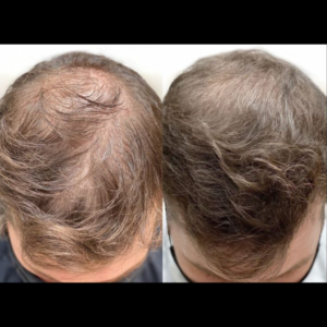 Gro-w hair growth products- results