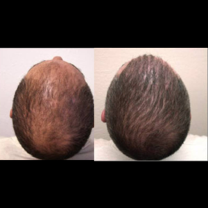 Gro-w hair growth products- results